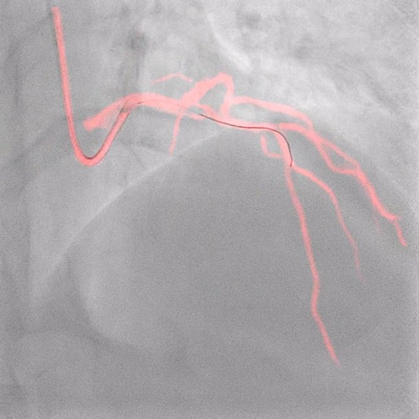 PHILIPS PRESENTS LATE-BREAKING DATA FROM DCR4CONTRAST STUDY